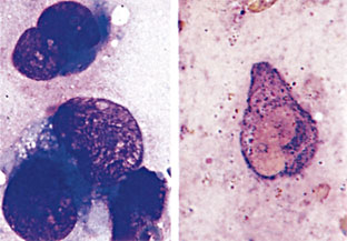 図3　骨髄（左）MG染色　（右）NAP染色