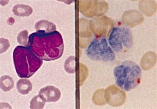 図1　末梢血　（左）MG染色（右）β-GI染色