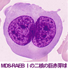 MDS-RAEB Tの二核の巨赤芽球