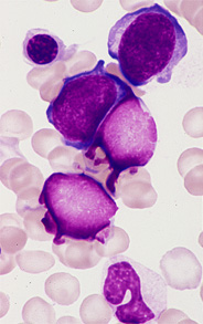 骨髄にみられた幼若リンパ球(juvenile lymphocyte)