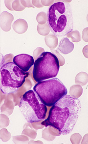 骨髄にみられた幼若リンパ球(juvenile lymphocyte)