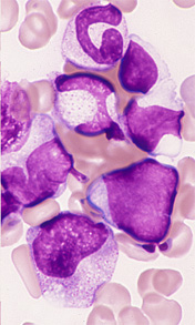 骨髄にみられた幼若リンパ球(juvenile lymphocyte)