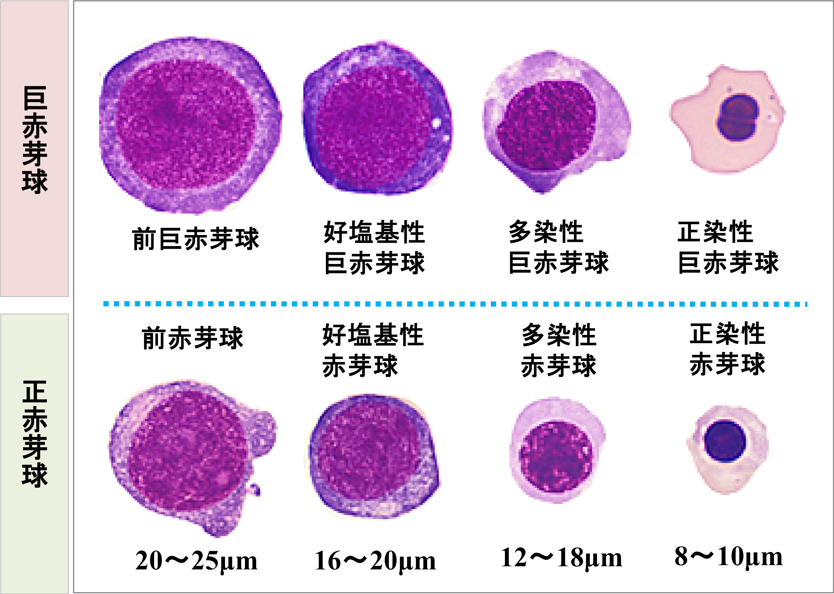 赤芽球の異形成 dyserythropoiesis
