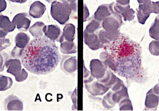 図3　末梢血　Acp染色