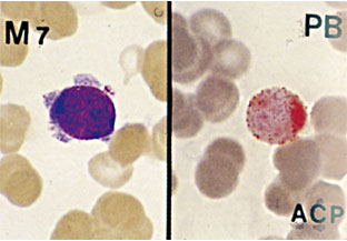 図4　末梢血　（左）MG染色（右）Acp染色