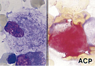 図5　骨髄　Acp染色［ゴーシェ病の症例］