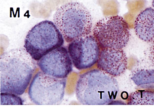 図2　骨髄　α-NB/NASDCA二重染色法